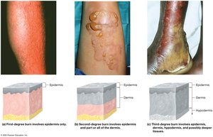 Second-degree burn