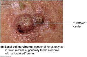 Basal cell carcinoma