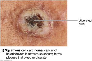 Squamous cell carcinoma
