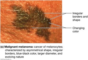 Malignant melanoma
