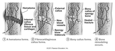 Fracture Repair Process