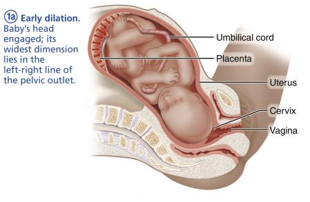 Late dilation stage of labor