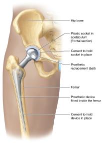 Hip joint replacement prosthesis