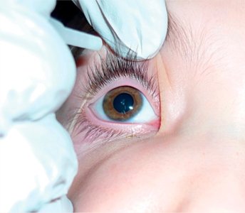 Instilling eye drops in a child