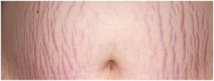 Striae (stretch marks) on the abdomen