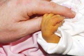 Jaundice: yellow discoloration of the skin in an infant