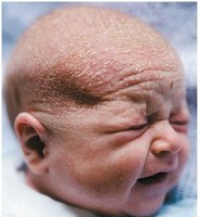 Infant with cradle cap (seborrhea)