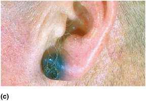 Melanoma on the ear