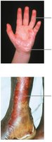 Images of partial-thickness (first and second degree) and full-thickness (third degree) burns
