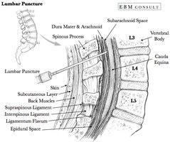 Lumbar puncture procedure and anatomical landmarks