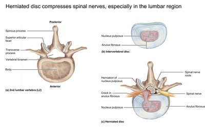 Herniated disc compressing spinal nerves, lumbar vertebra and disc anatomy