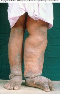Clinical image of lymphedema in the legs