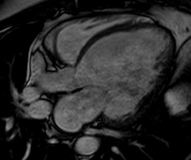 Cardiac MRI: normal heart