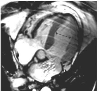 Takotsubo cardiomyopathy: systole with apical ballooning