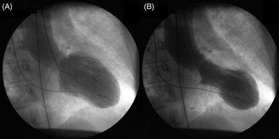 Takotsubo cardiomyopathy: diastole