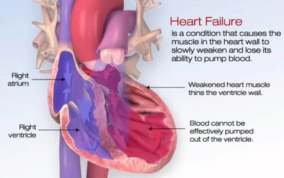 Heart failure: weakened heart muscle and impaired pumping