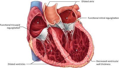 Dilated cardiomyopathy: dilated chambers and thin walls