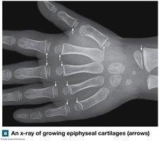X-ray of growing epiphyseal cartilages