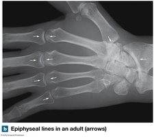 Epiphyseal lines in adult