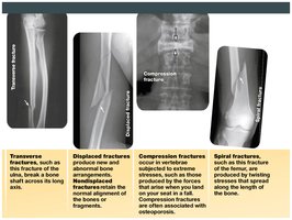 Types of fractures