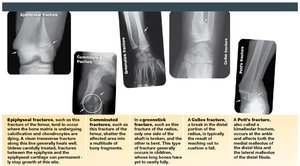Types of fractures