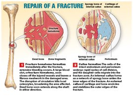 Repair of a fracture: hematoma and callus formation