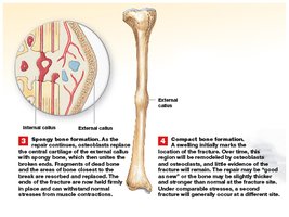 Repair of a fracture: spongy and compact bone formation