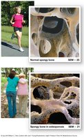 Effects of osteoporosis on spongy bone