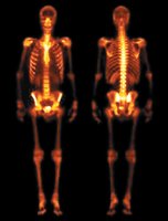 Nuclear medicine scan showing radioisotope distribution in the body