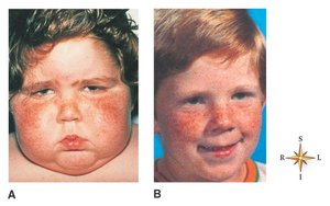 Cushing syndrome (hypersecretion of glucocorticoids)