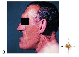 Acromegaly due to GH hypersecretion in adulthood