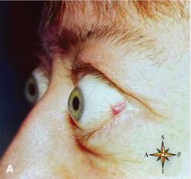 Exophthalmos in Graves disease (hyperthyroidism)