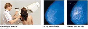 Mammograms