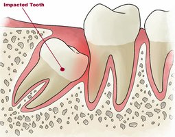 Impacted tooth (wisdom tooth)