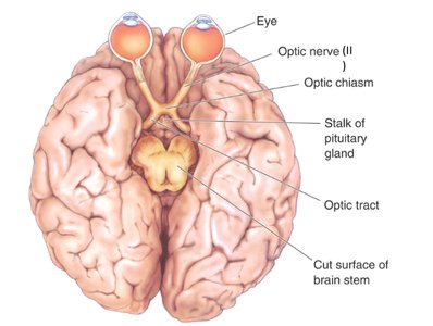 Brain showing optic nerve, optic chiasm, pituitary gland, and optic tract