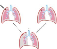 Pneumothorax: air in pleural cavity and lung collapse