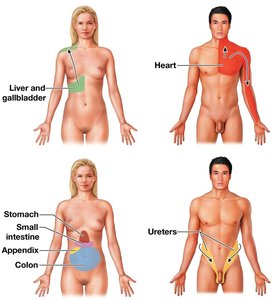 Diagram of referred pain patterns