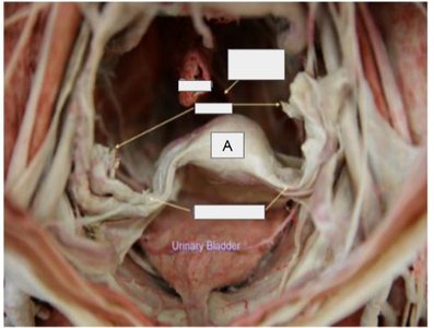 cadaver dissection showing pelvic cavity and urinary bladder