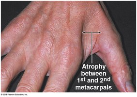 Muscle atrophy between metacarpals