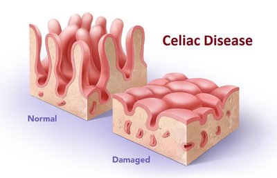 Diagram showing normal and damaged villi in celiac disease