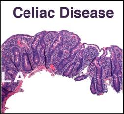 Histological comparison: normal vs celiac disease villi
