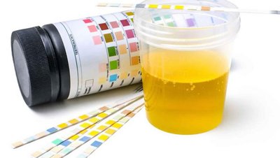 Urinalysis test strips