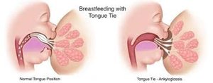 Breastfeeding with tongue tie (ankyloglossia)