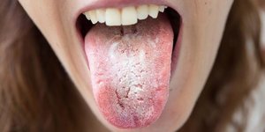 Dry mouth (xerostomia)