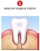 Gingivitis