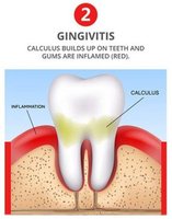 Progression from healthy gums to periodontitis