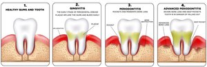Advanced periodontitis