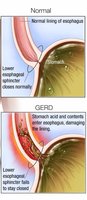 GERD and normal esophagus