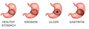 Healthy stomach, erosion, ulcer, gastritis