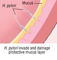 H. pylori invading stomach mucosa